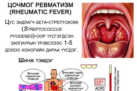 Хоолойны ангина